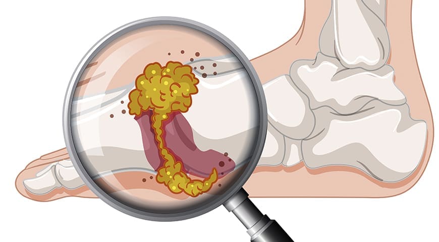 Hiperuricemia Gota