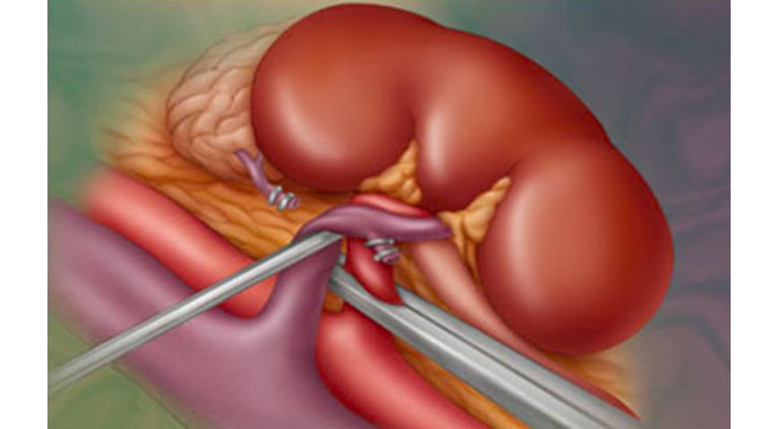 Trasplante renal